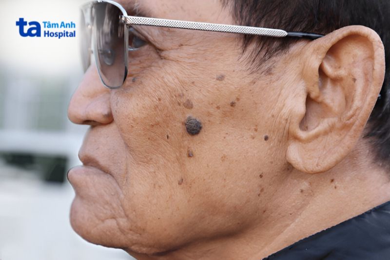 bị đồi mồi do tác động từ tia UV