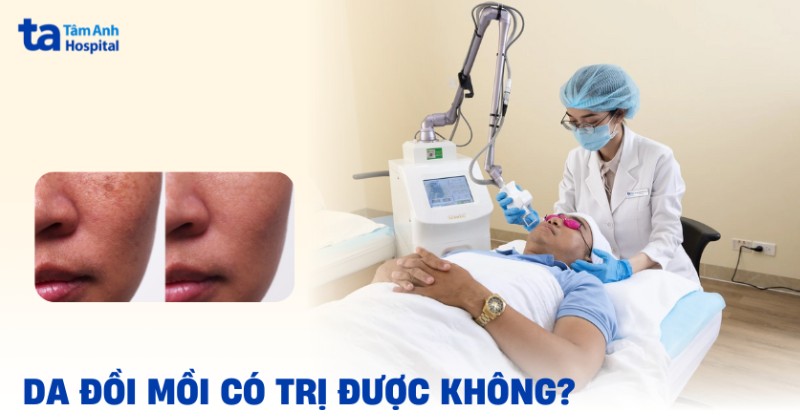 Da bị đồi mồi có trị được không? Làm sao hết hoàn toàn?