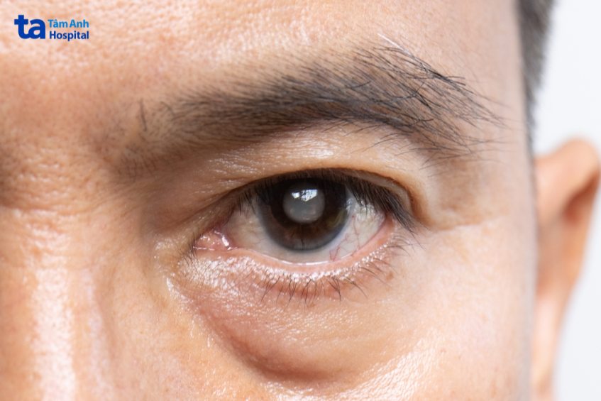 đục thủy tinh thể là biến chứng viêm màng bồ đào