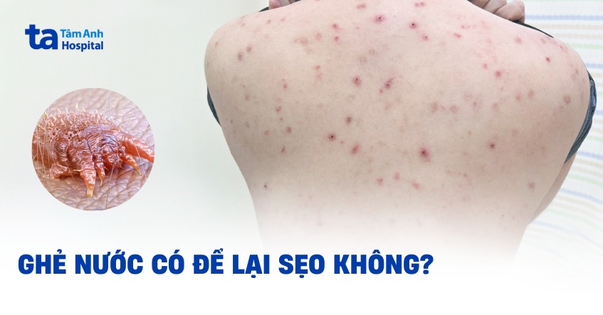 Ghẻ nước có để lại sẹo không? Cách phòng ngừa và xử lý hiệu quả