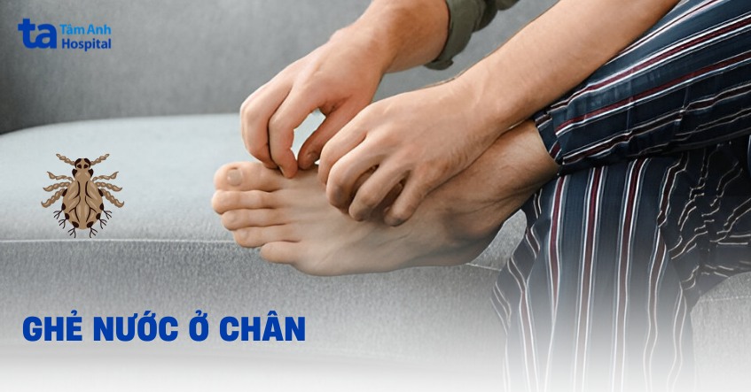 Ghẻ nước ở chân: Hình ảnh, nguyên nhân, dấu hiệu và phòng ngừa