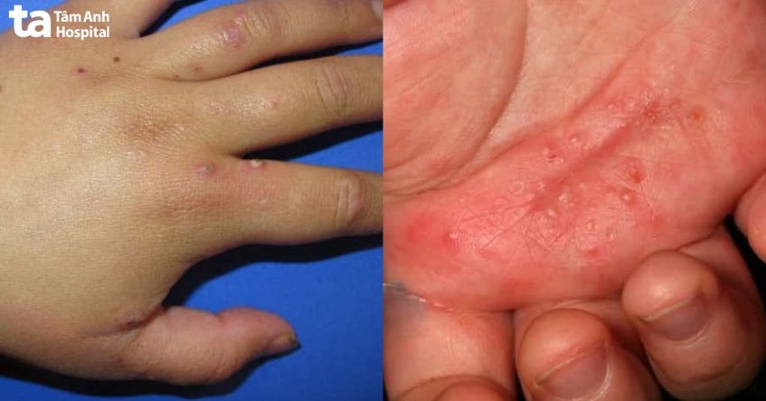 ghẻ nước ở tay là bệnh gì