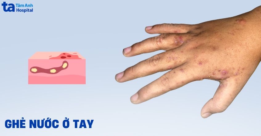 Ghẻ nước ở tay: Hình ảnh, nguyên nhân, dấu hiệu và phòng ngừa