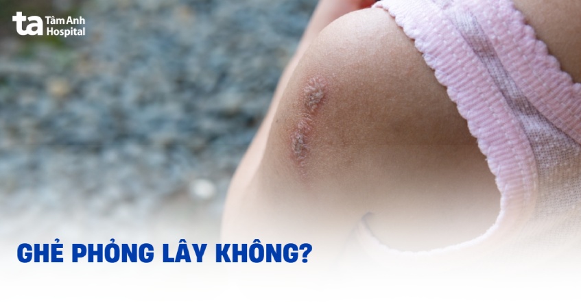 ghẻ phỏng có lây không