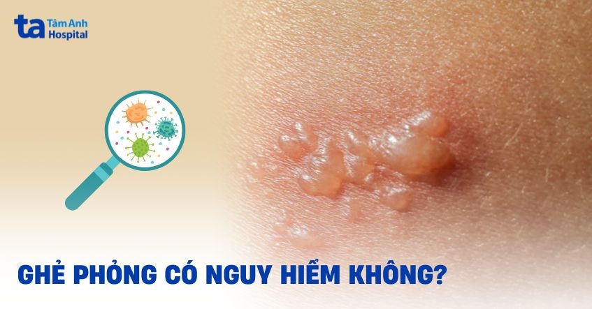 Ghẻ phỏng có nguy hiểm không? Có ảnh hưởng tính mạng không?