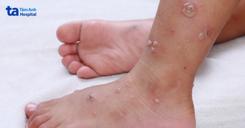 ghẻ phỏng thường xuất hiện ở trẻ em