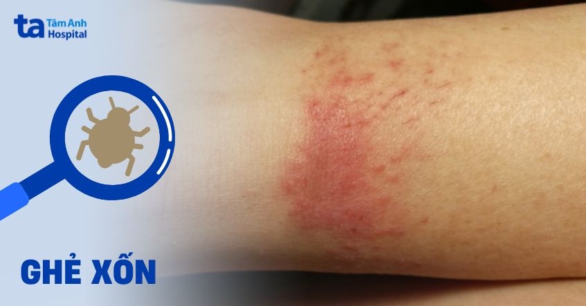Ghẻ xốn: Hình ảnh, nguyên nhân, dấu hiệu và cách điều trị