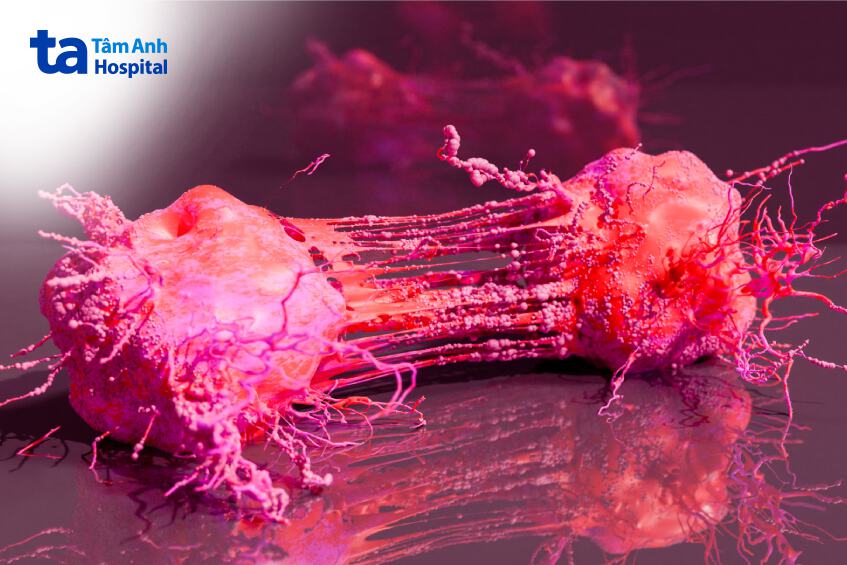 giai đoạn phát triển ung thư biểu mô tuyến vú