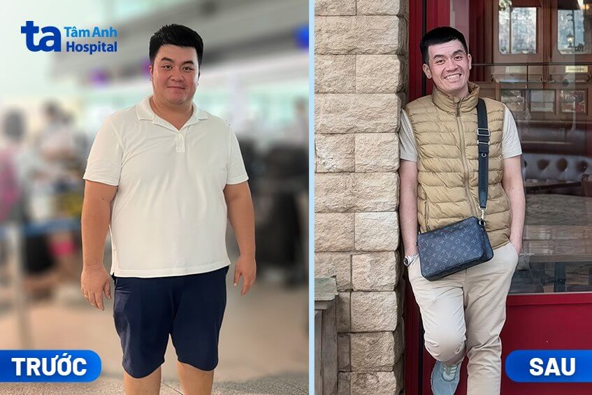 giảm cân sau thu nhỏ dạ dày