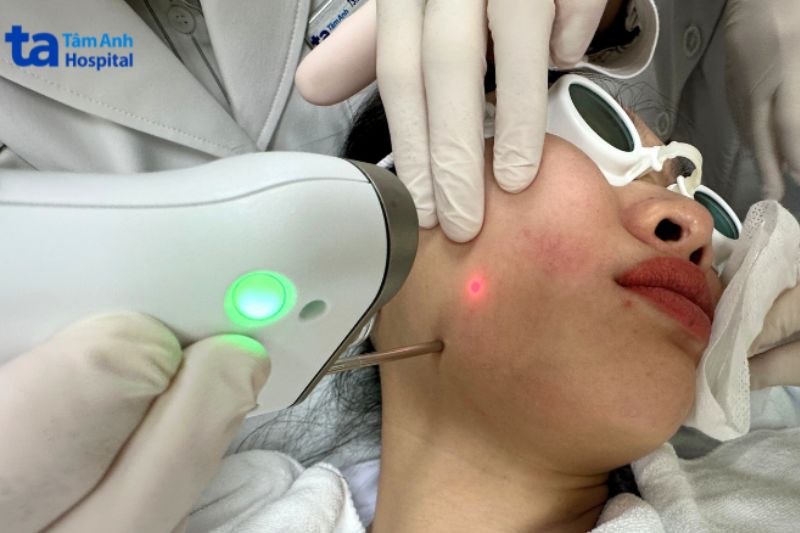 máy Fotona 4D Dynamis điều trị giãn mao mạch