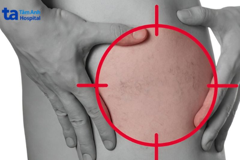 da giãn mao mạch thường có màu đỏ