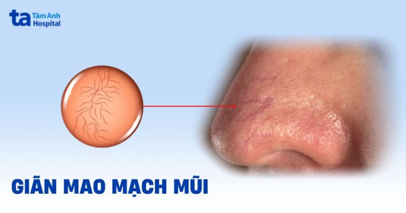 Giãn mao mạch mũi: Nguyên nhân, cách điều trị và những lưu ý
