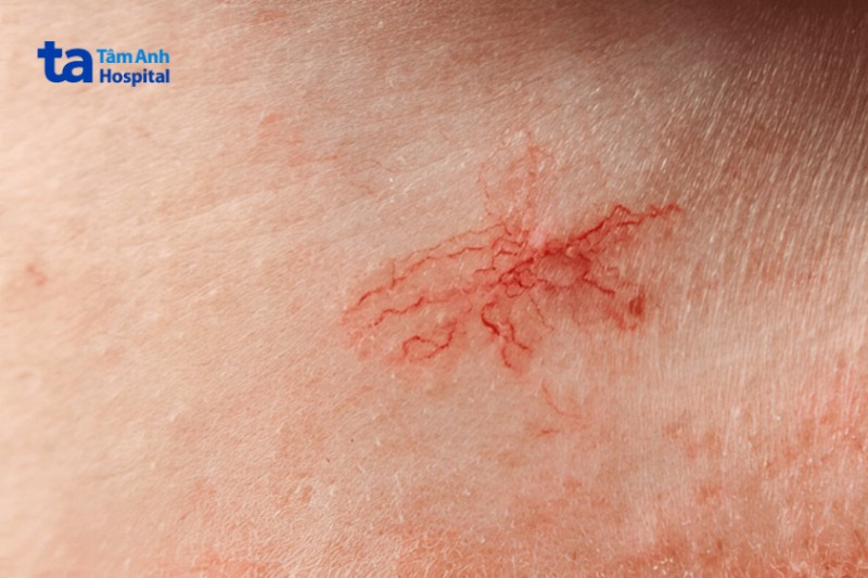 giãn mao mạch ở mặt có thể điều trị