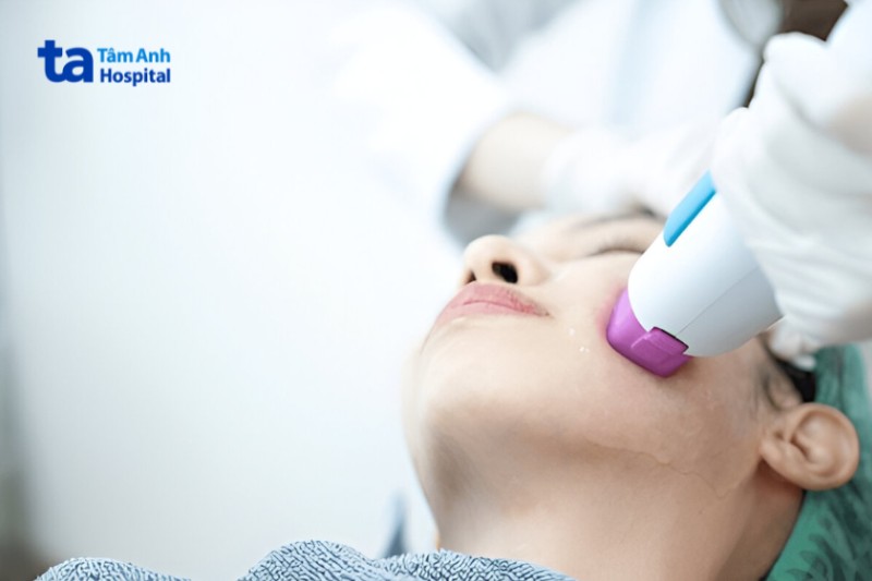 điều trị giãn mao mạch ở mặt bằng Laser