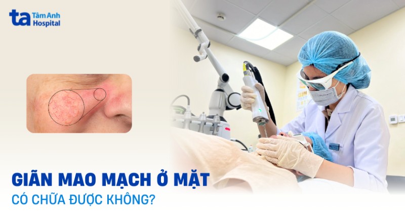 Giãn mao mạch ở mặt có chữa được không? Phương pháp điều trị