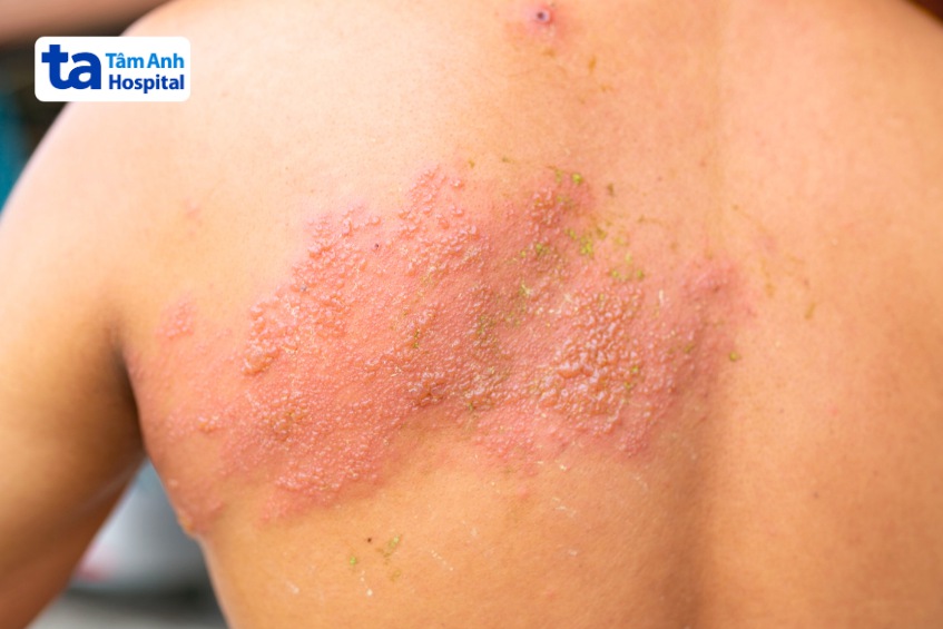 giữ cho vùng da bị zona khô khoáng