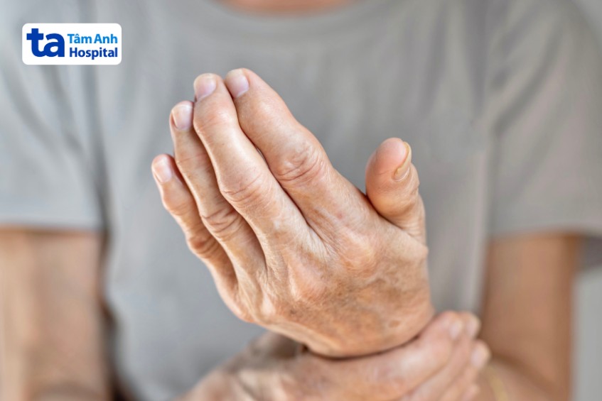 gout bị đau khớp bàn tay