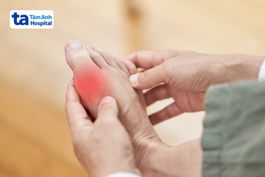 gout gây đau khớp bàn chân