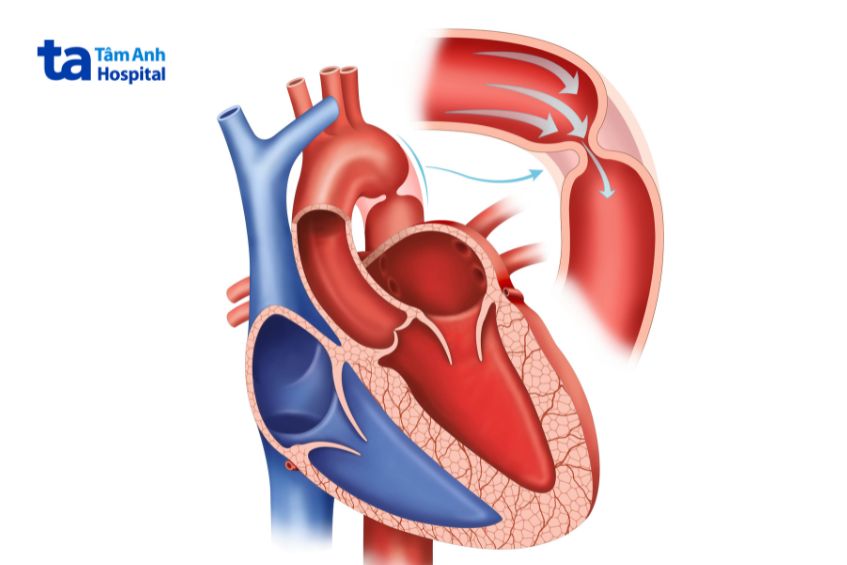Hẹp eo động mạch chủ làm hạn chế lưu lượng máu đến phần dưới của cơ thể