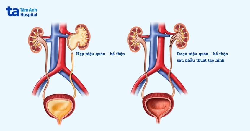 hẹp niệu quản bể thận sau phẫu thuật tạo hình