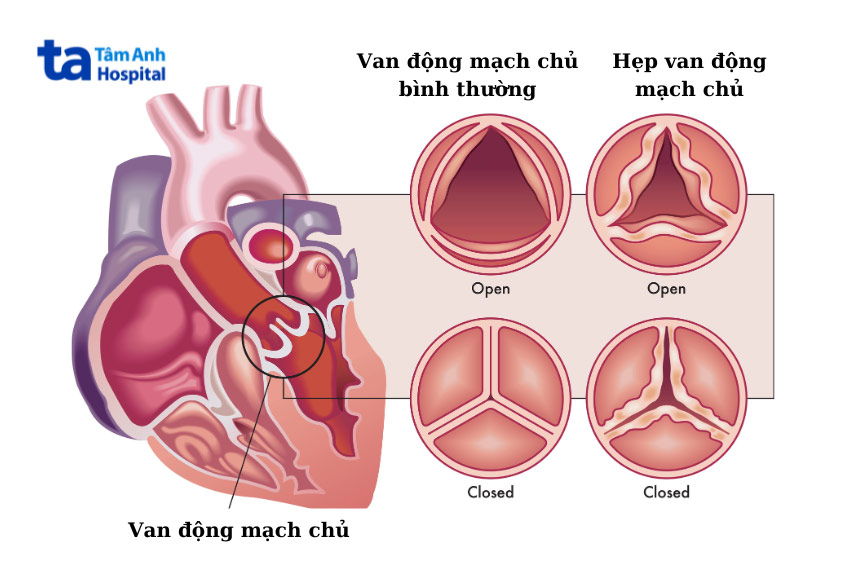 Hẹp van động mạch chủ là bệnh van tim thường gặp