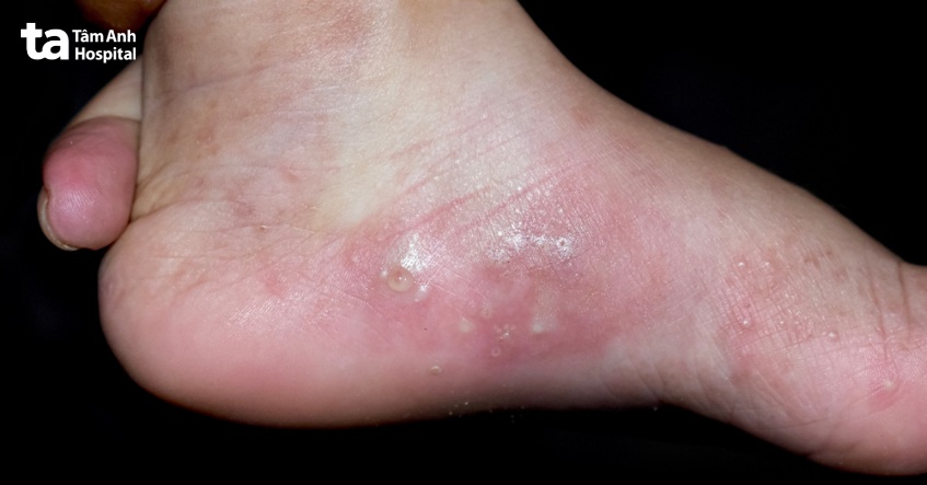 hình ảnh ghẻ nước ở chân thực tế