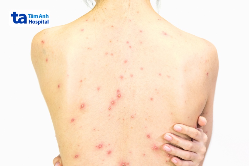 hình ảnh mẹ bầu mắc thủy đậu