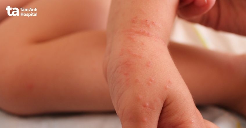 hình ảnh nhận biết bệnh ghẻ ruồi thực tế