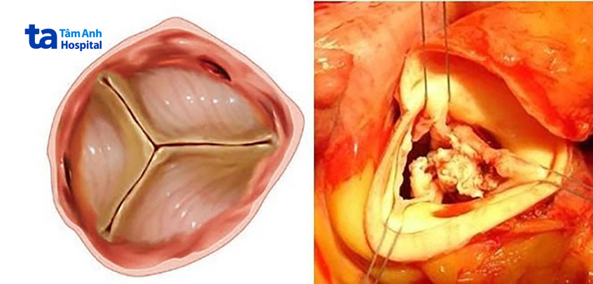 Hình ảnh sùi trên van động mạch chủ ở bệnh nhân viêm nội tâm mạc nhiễm khuẩn