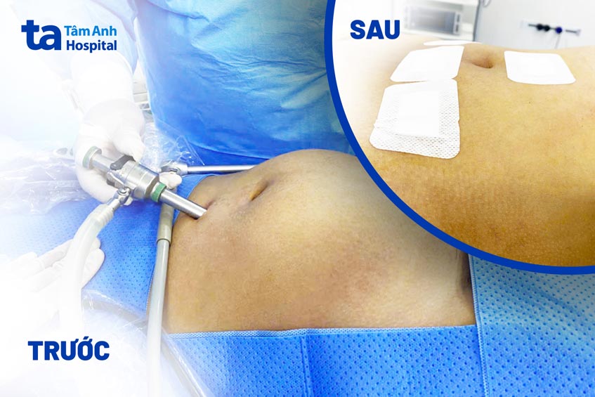 hình ảnh trước và sau phẫu thuật