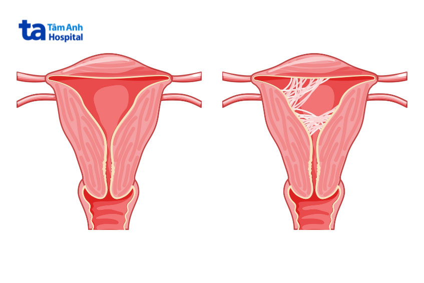 hình ảnh tử cung bị dính