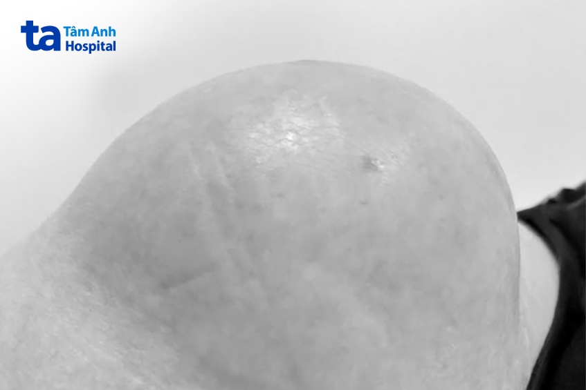 hình ảnh u bã đậu