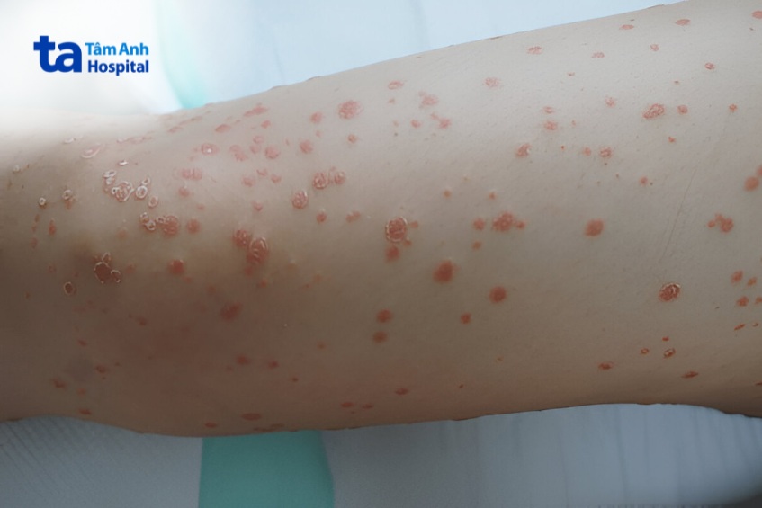 hình ảnh vảy nến thể giọt