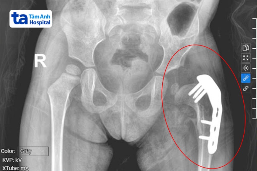 hình ảnh x quang cho thấy bé trinh bị trật khớp háng bẩm sinh