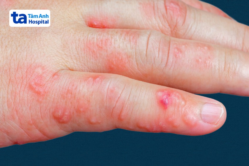 hình ảnh zona thần kinh