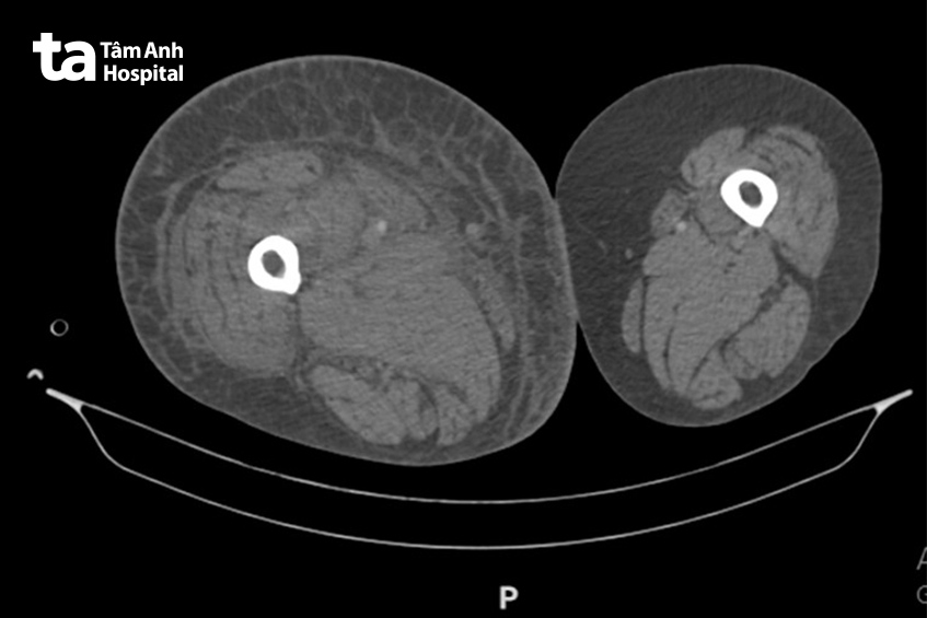 Hình ảnh chụp CT lát cắt ngang đùi người bệnh, tại vị trí tĩnh mạch đùi (gần trung tâm xương) phát hiện huyết khối gây tắc nghẽn dòng máu