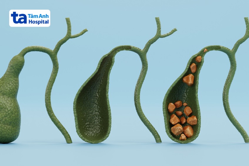 hình thành sỏi mật