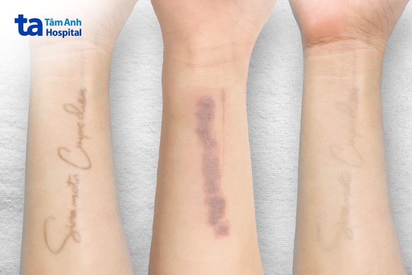 hình xăm trước và sau điều trị
