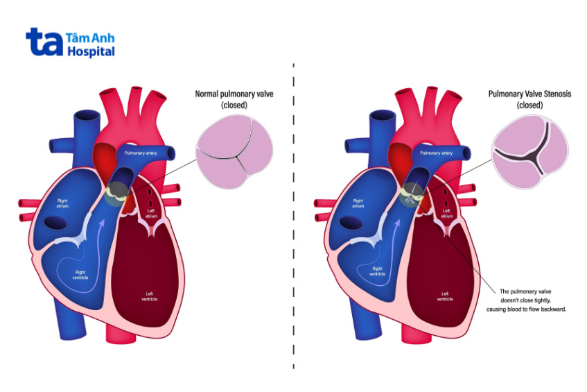 Hở van động mạch phổi khiến máu bị trào ngược về tâm thất phải