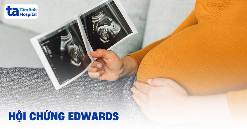 Hội chứng Edwards: Nguyên nhân, triệu chứng, chẩn đoán, phòng ngừa