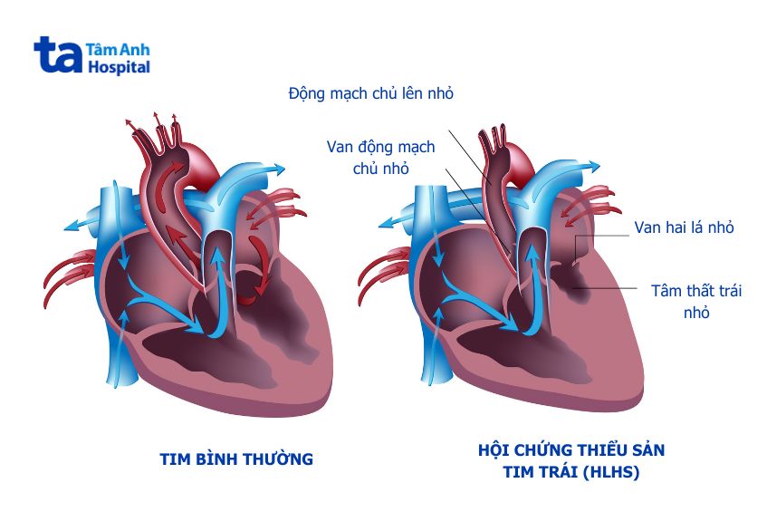 Hội chứng thiểu sản tim trái là dị tật tim bẩm sinh rất nặng