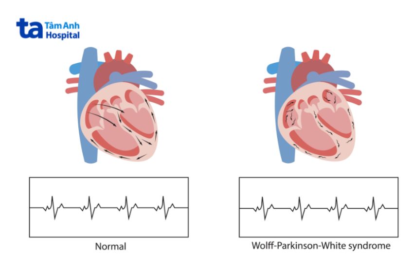 Hội chứng Wolff-Parkinson-White (WPW) có liên quan đến dị tật Ebstein