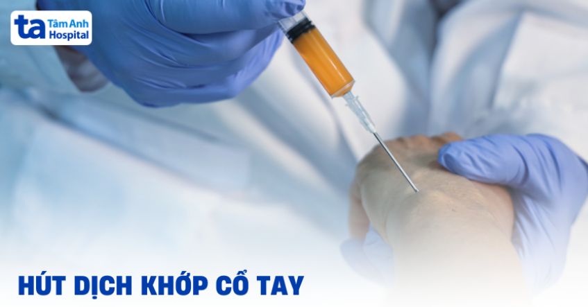 Chọc hút dịch khớp cổ tay: Quy trình, kỹ thuật và cách thực hiện