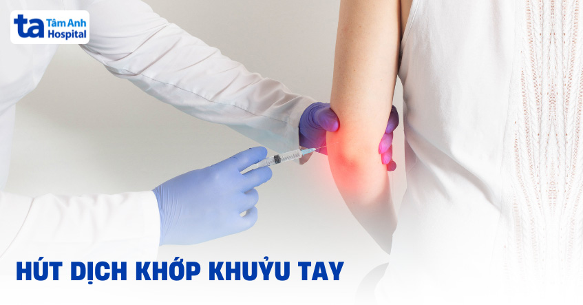 Chọc hút dịch khớp khuỷu tay: Quy trình và kỹ thuật thực hiện