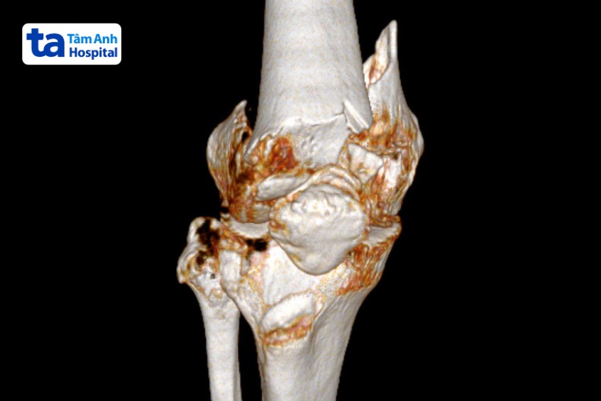 kết quả ct xương đùi vỡ nát của bệnh nhân