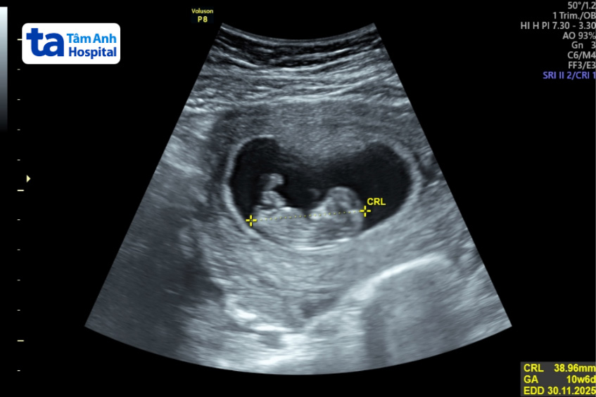 Kết quả siêu âm cho thấy chị Tiền có thai hơn 12 tuần