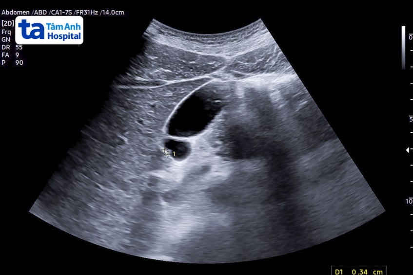 khám polyp túi mật