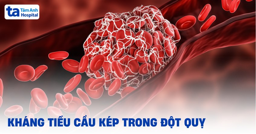 Kháng tiểu cầu kép trong đột quỵ: Chỉ định, hiệu quả, tác dụng phụ