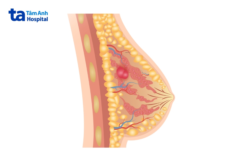 khi nào áp xe vú được tiểu phẫu