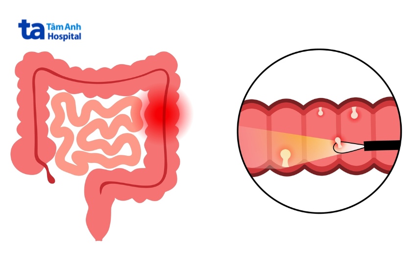 khoảng cách nội soi đại tràng 2 lần